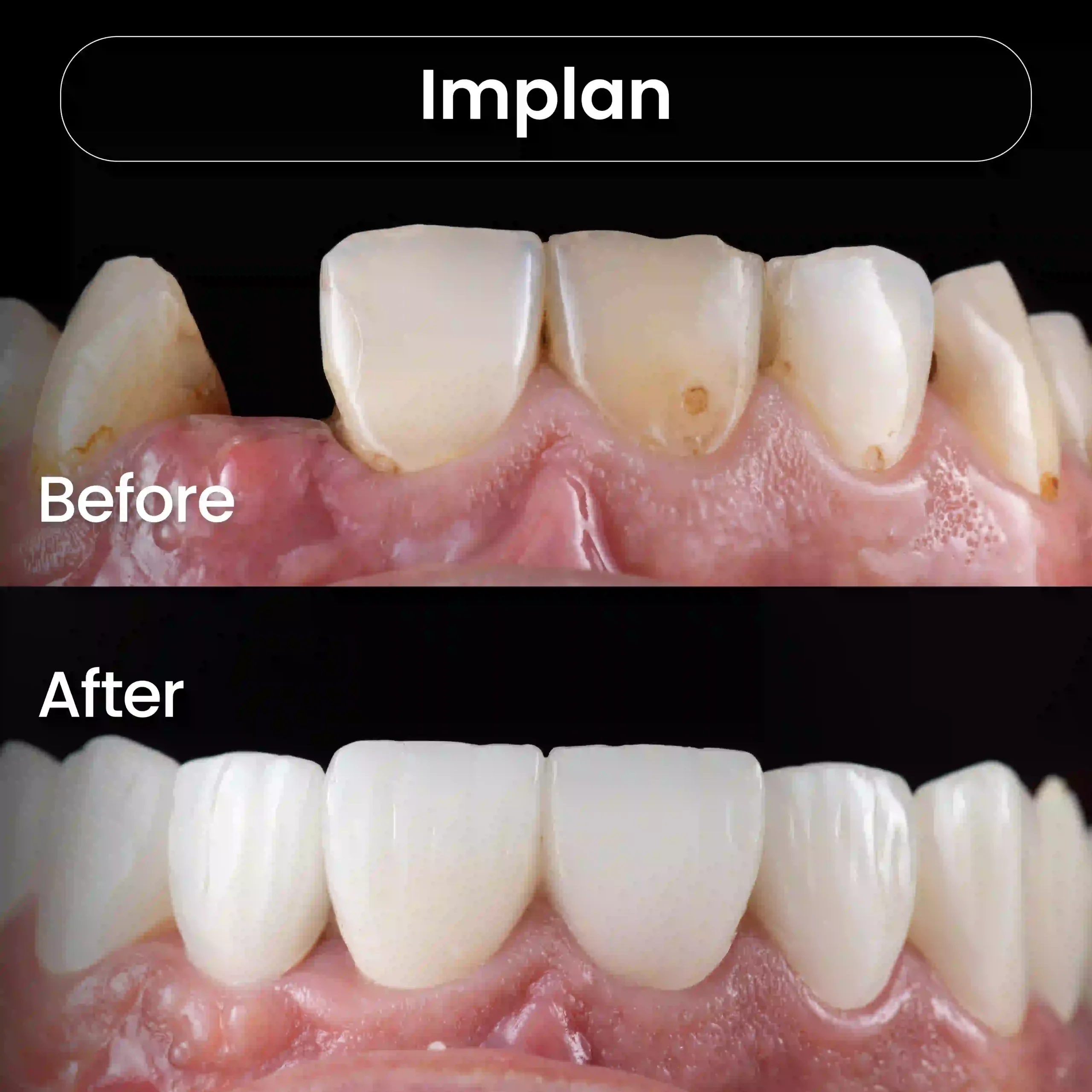 Before After SIA_Implan 1
