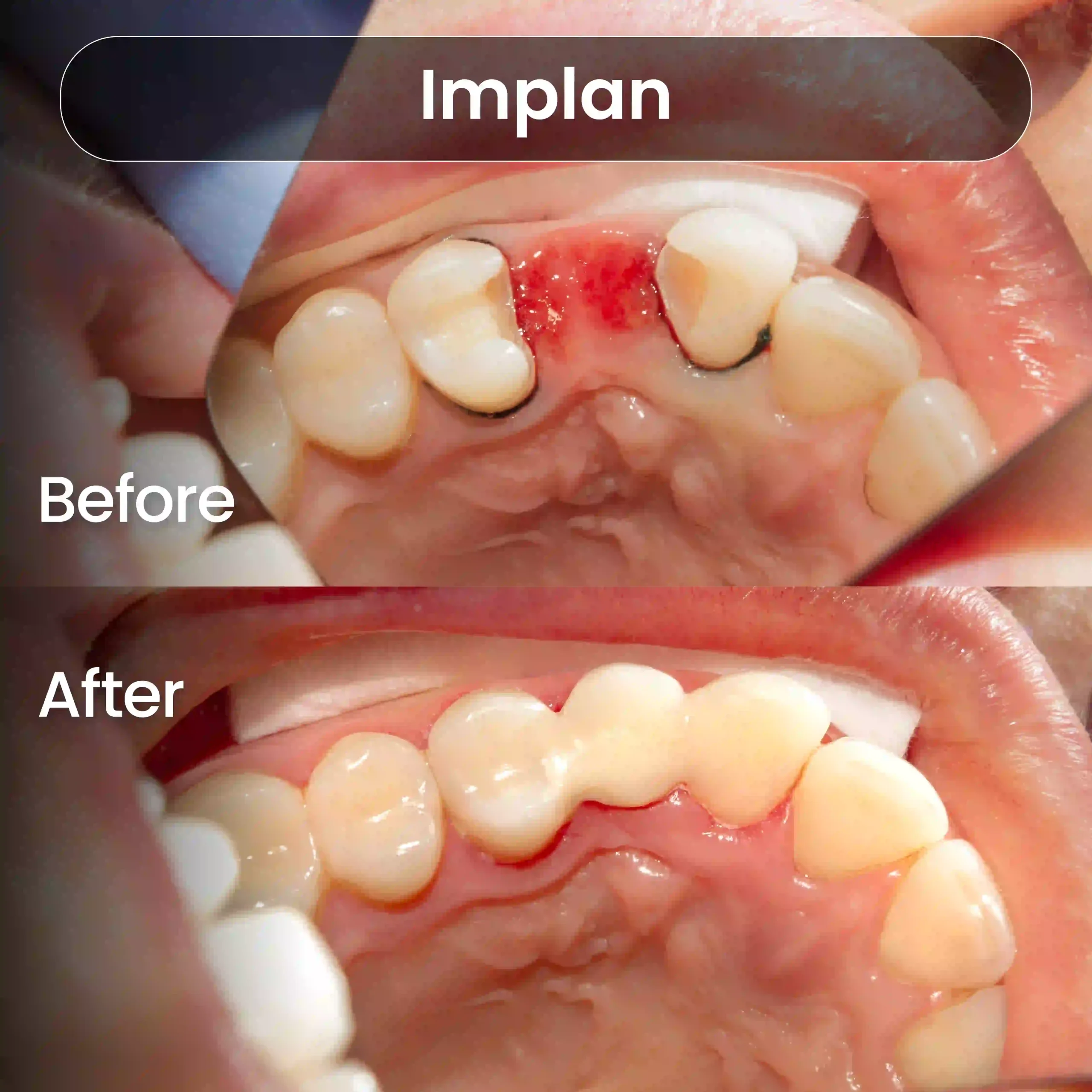 Before After SIA_Implan 2