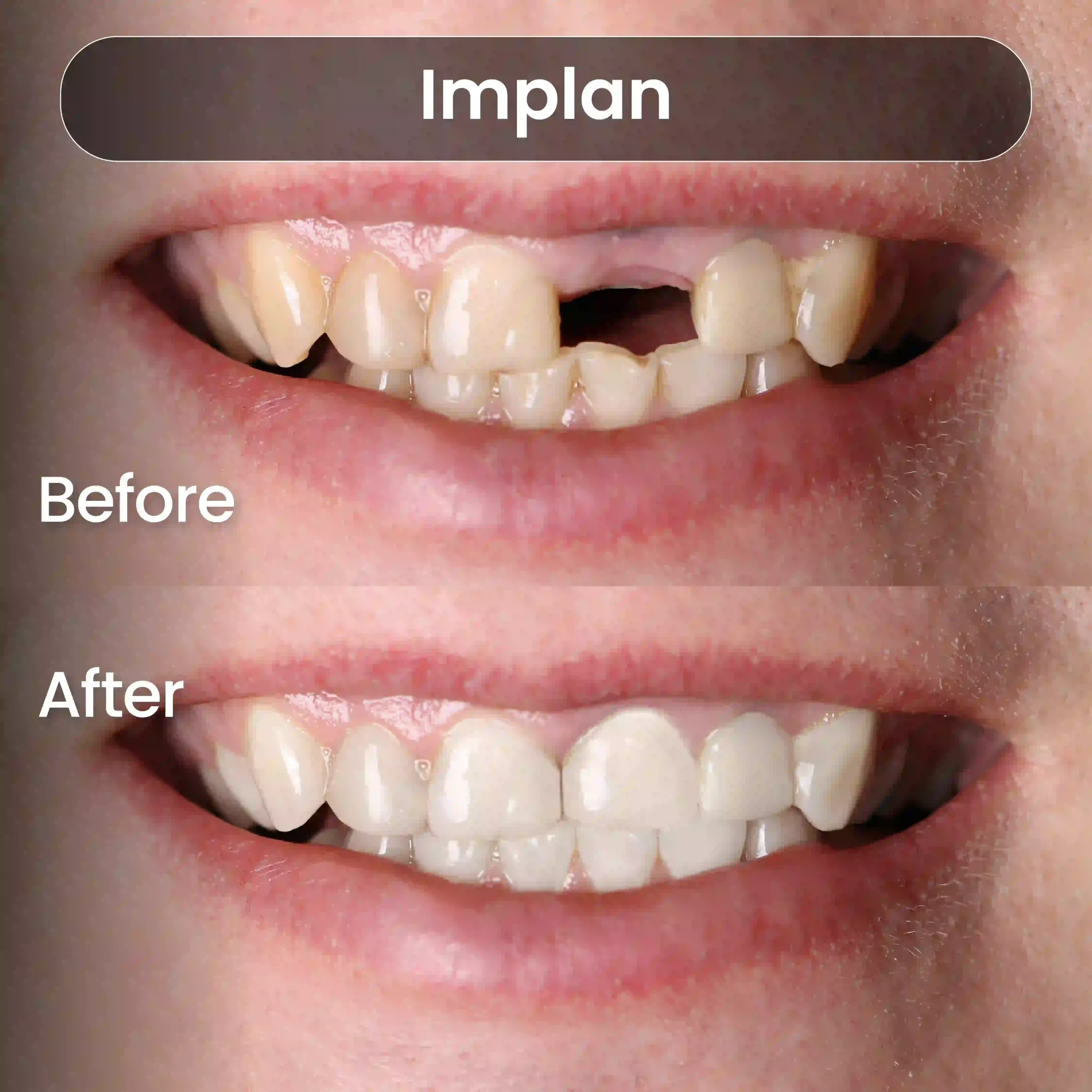 Before After SIA_Implan 4
