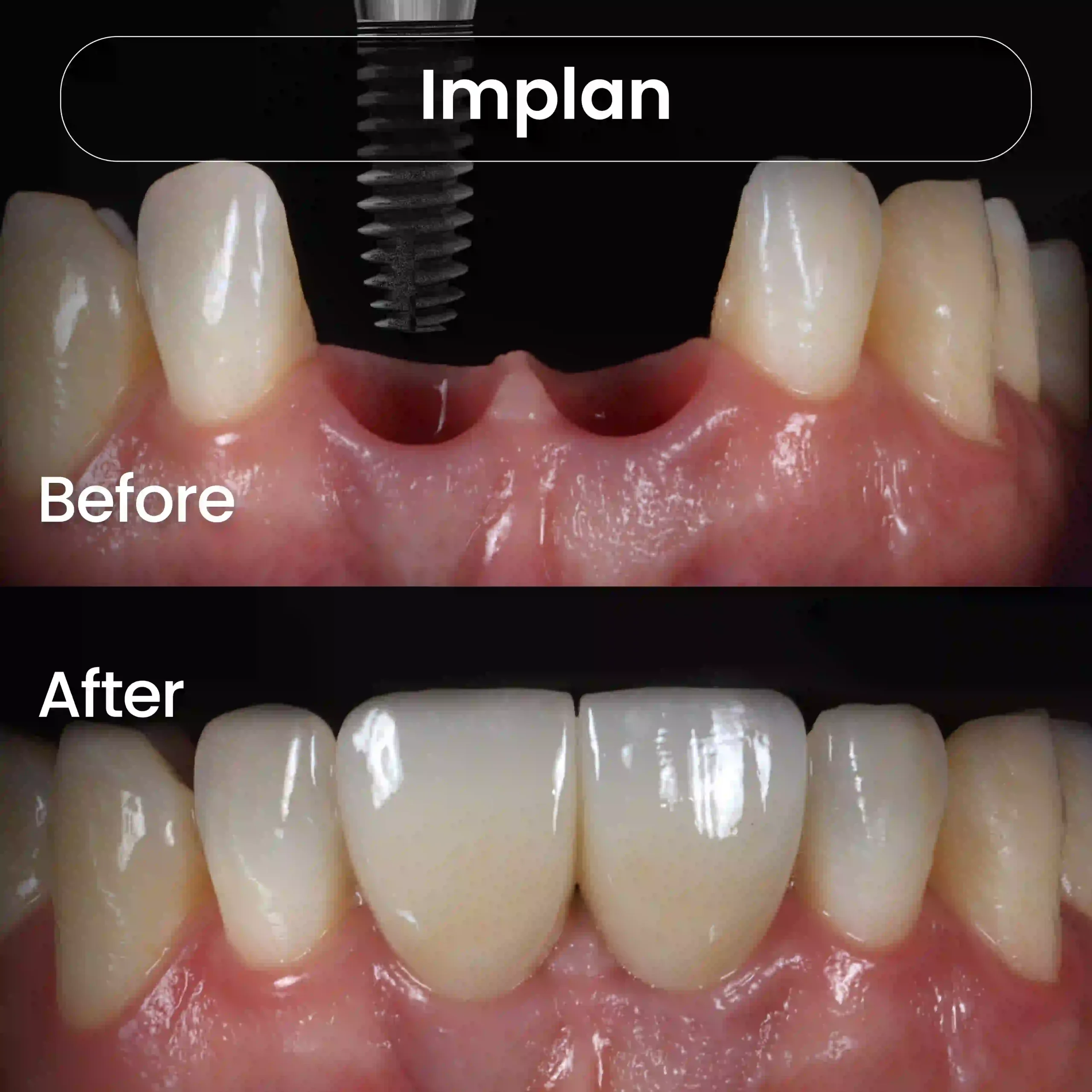Before After SIA_Implan 5