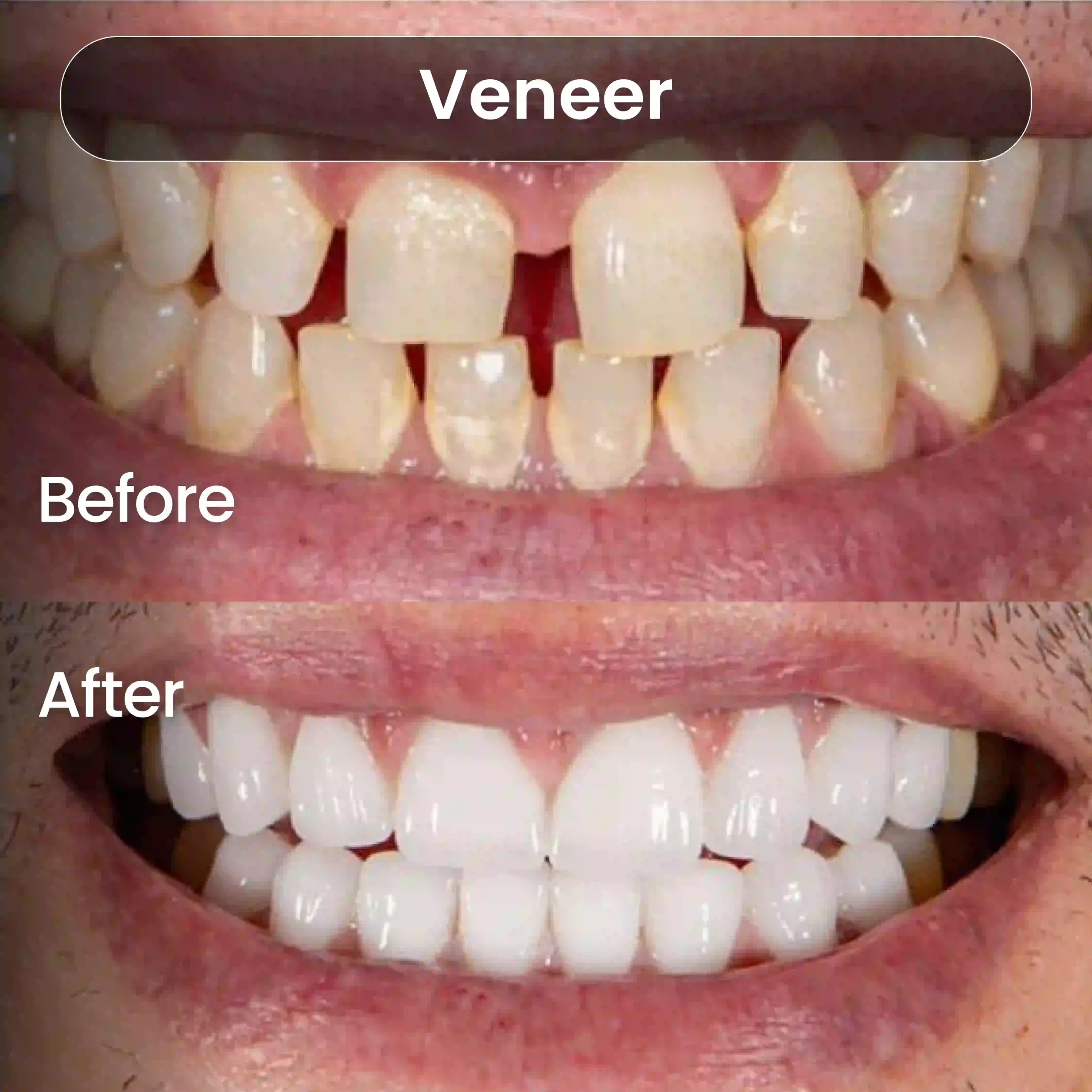 Before After SIA_Veneer 3