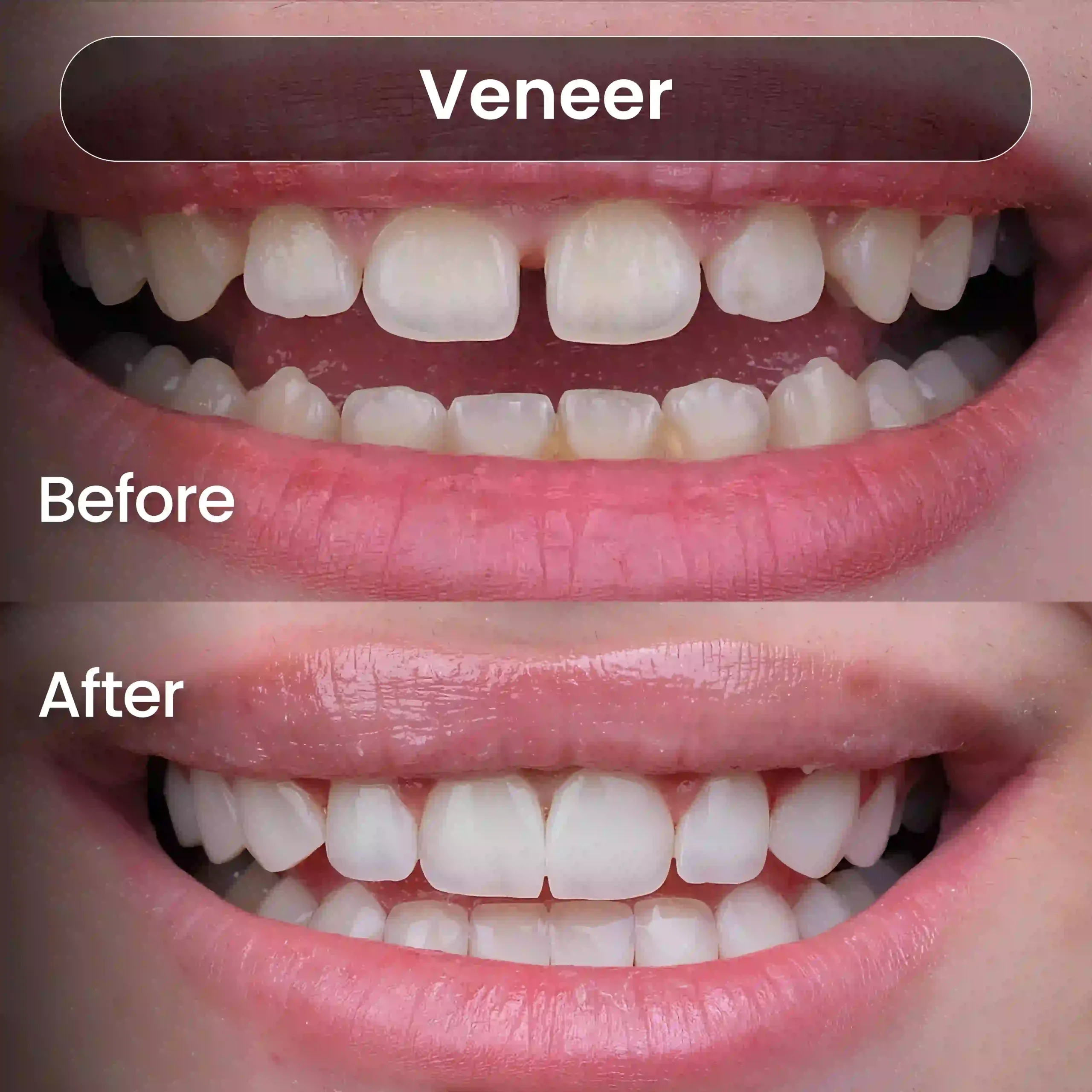 Before After SIA_Veneer 4