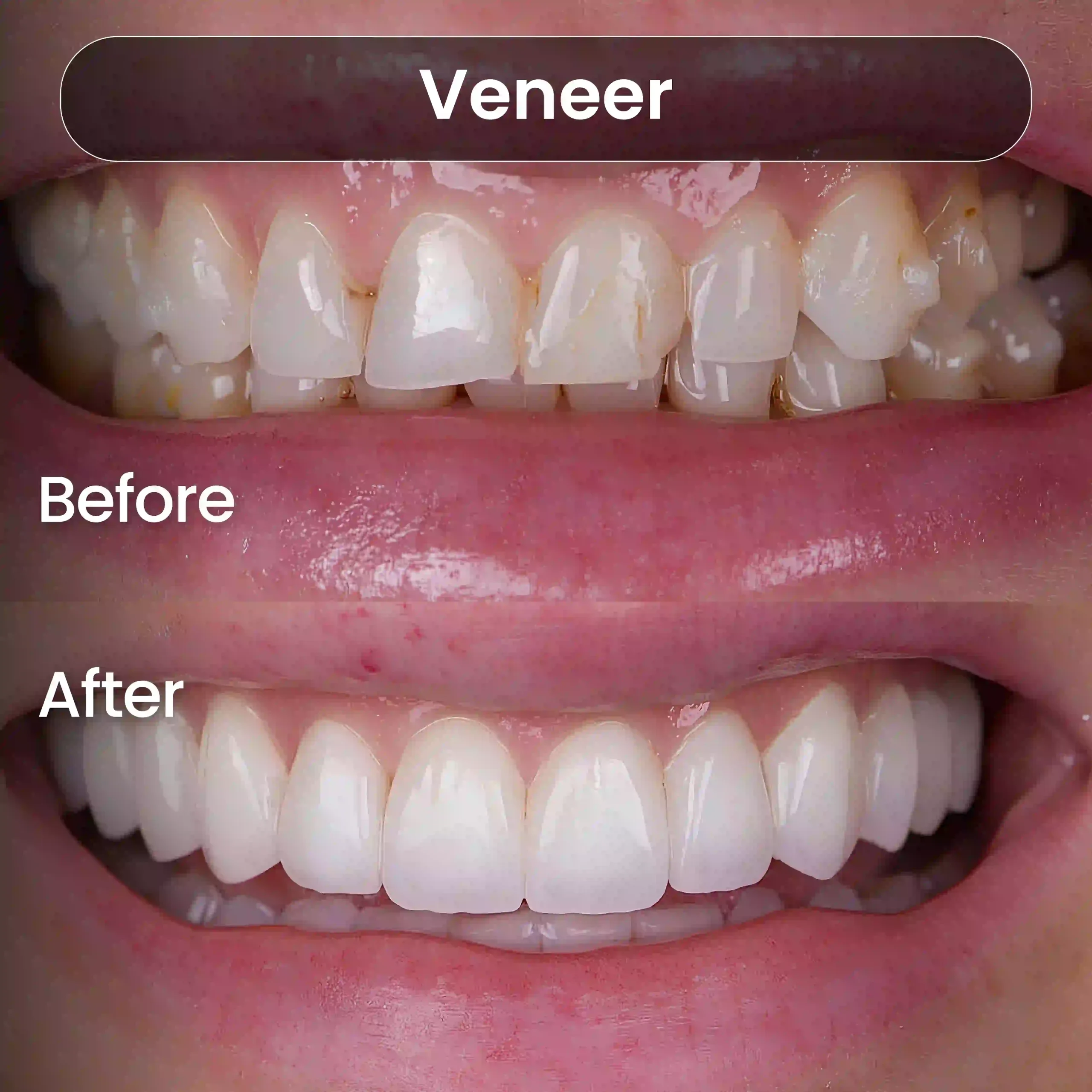 Before After SIA_Veneer 5
