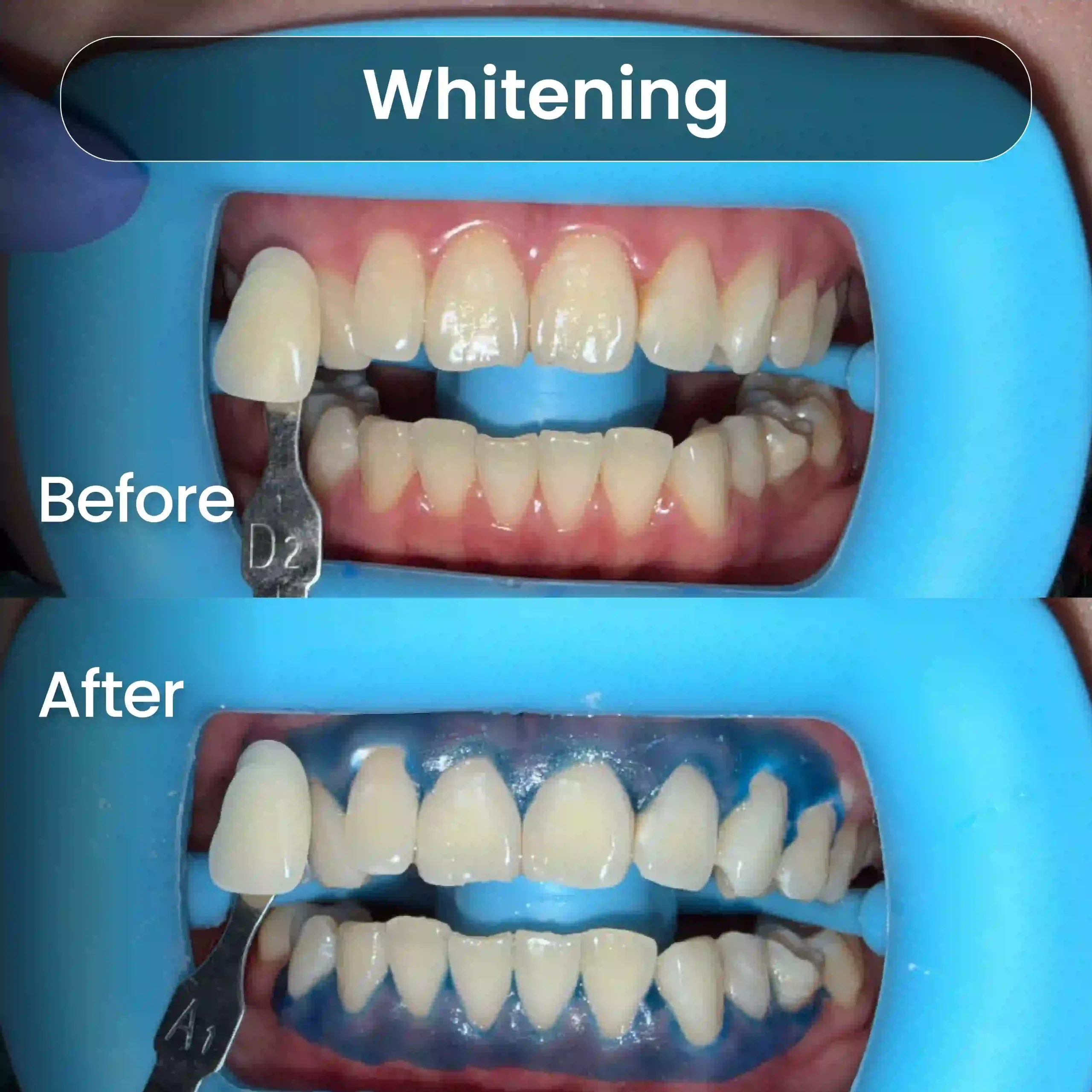 Before After SIA_Whitening 1