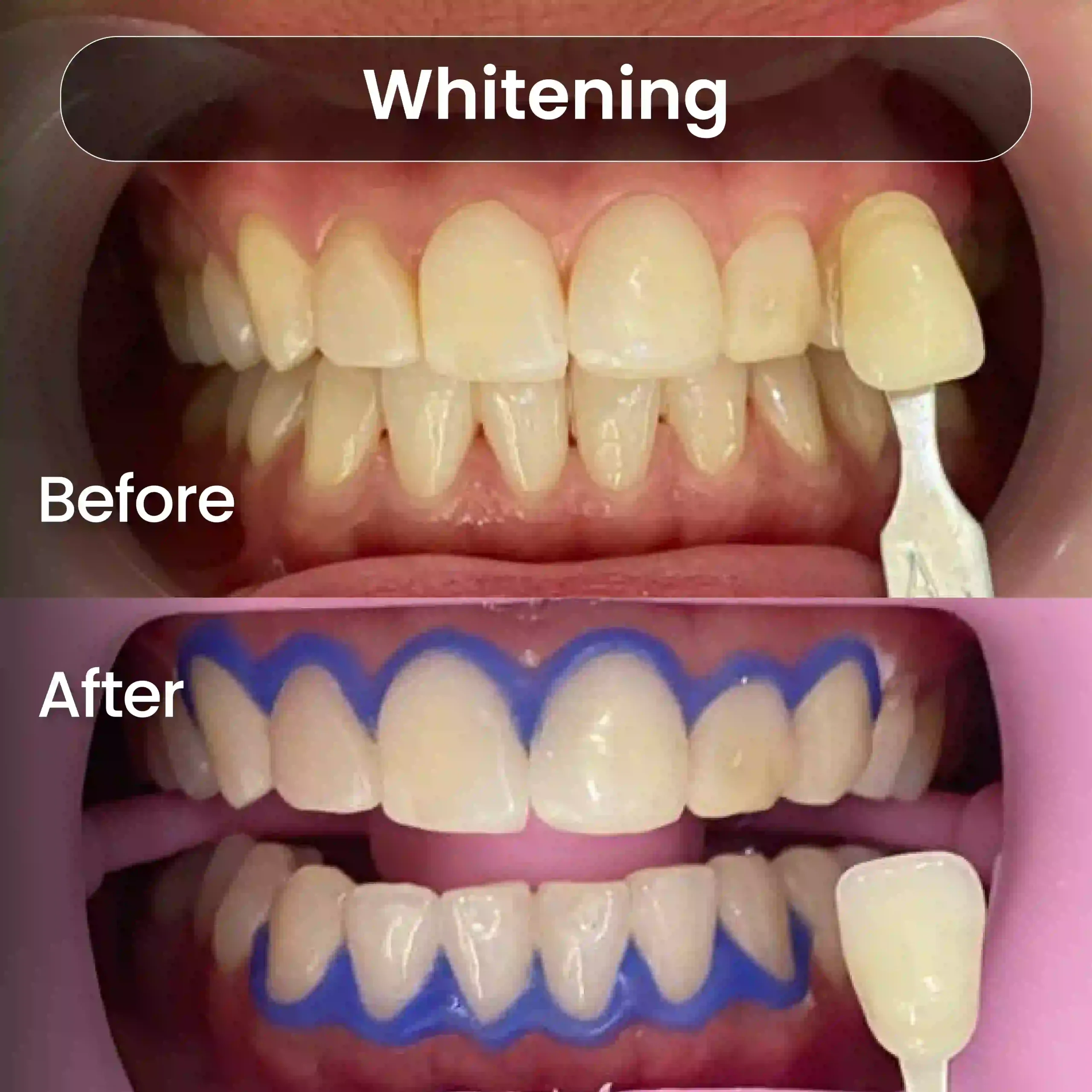 Before After SIA_Whitening 3