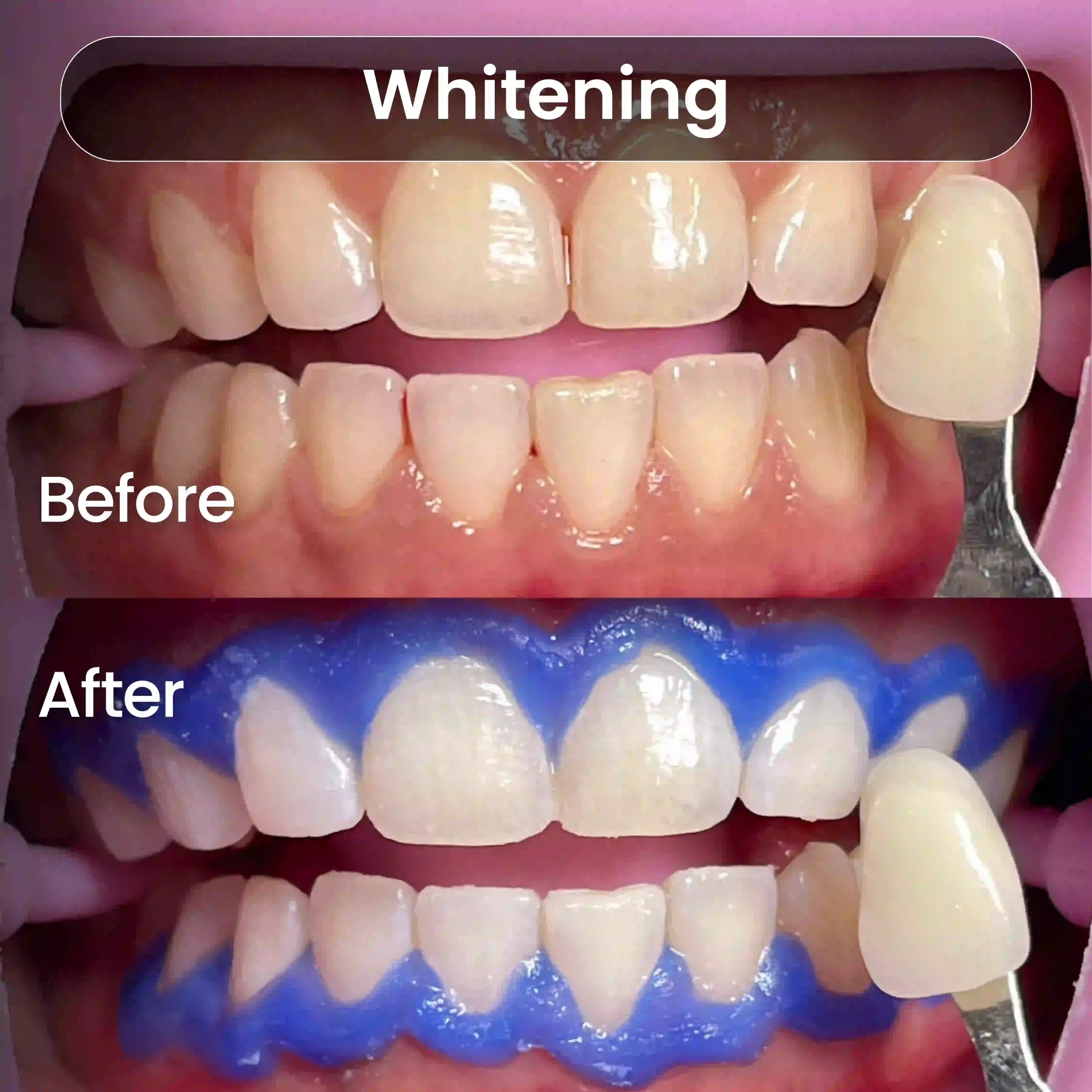 Before After SIA_Whitening 4
