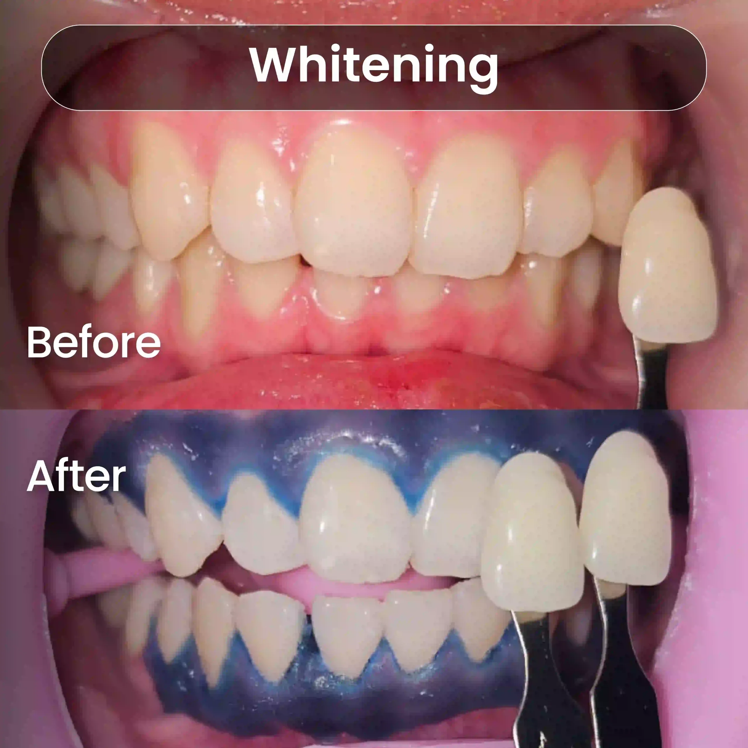 Before After SIA_Whitening 5